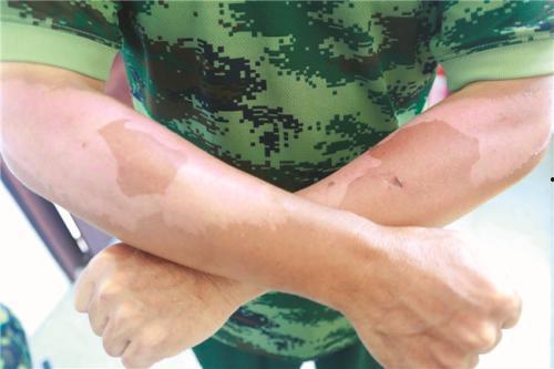 晒脱皮了图片,晒脱皮了怎么办？